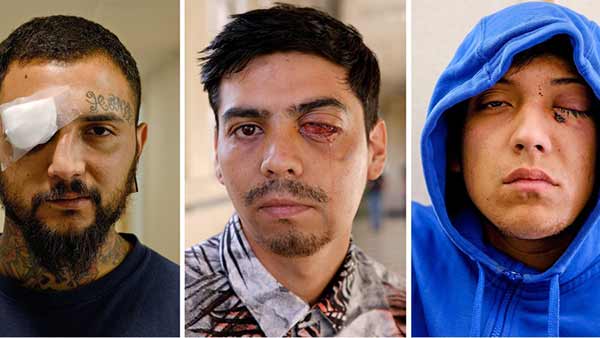 Chilean Protester Eye Damage